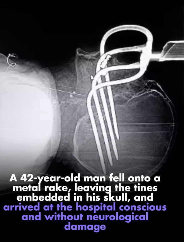 People believe that x rays are dangerous. Not in this case, couse is dead!