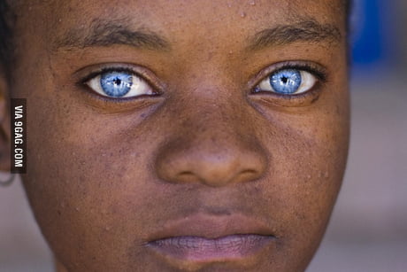 The Beautiful Blue Eyes Of People With Waardenburg Syndrome 9gag