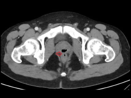 Man Poops Out Of Penis And Ejaculates Semen From Butt Due To Rare Condition - 9GAG