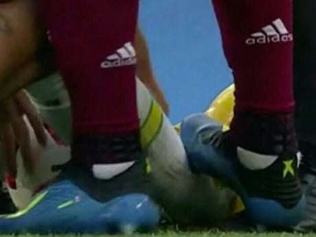 Funny how people post the scene but hide the Mexican player stepping on his operated ankle.