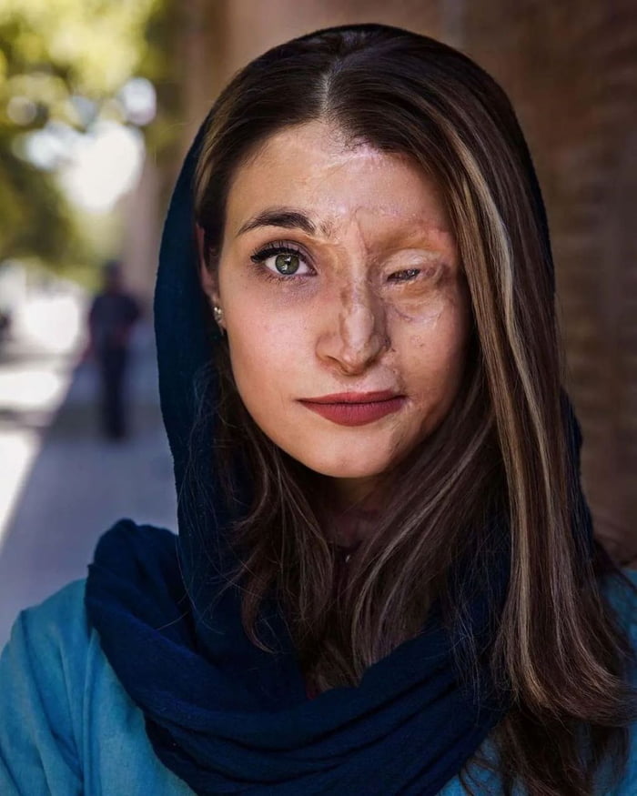 Marzieh Ebrahimi, an Iranian survivor of an unprovoked acid attack in 2014 for wearing a "bad hijab"