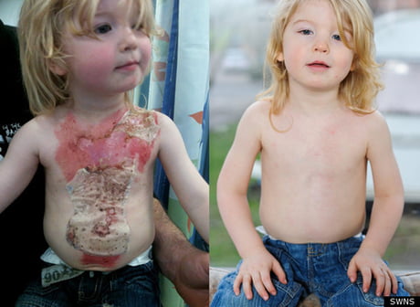 Burn treated with spray on skin