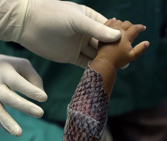 Doctors in Brazil are using Talapia fish skin to help burns cure, it has tons if collagen and non infective microbiota.