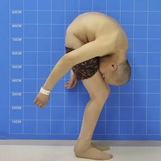 Man Folded For 28 Years Can Now Stand Straight After Risky Surgery