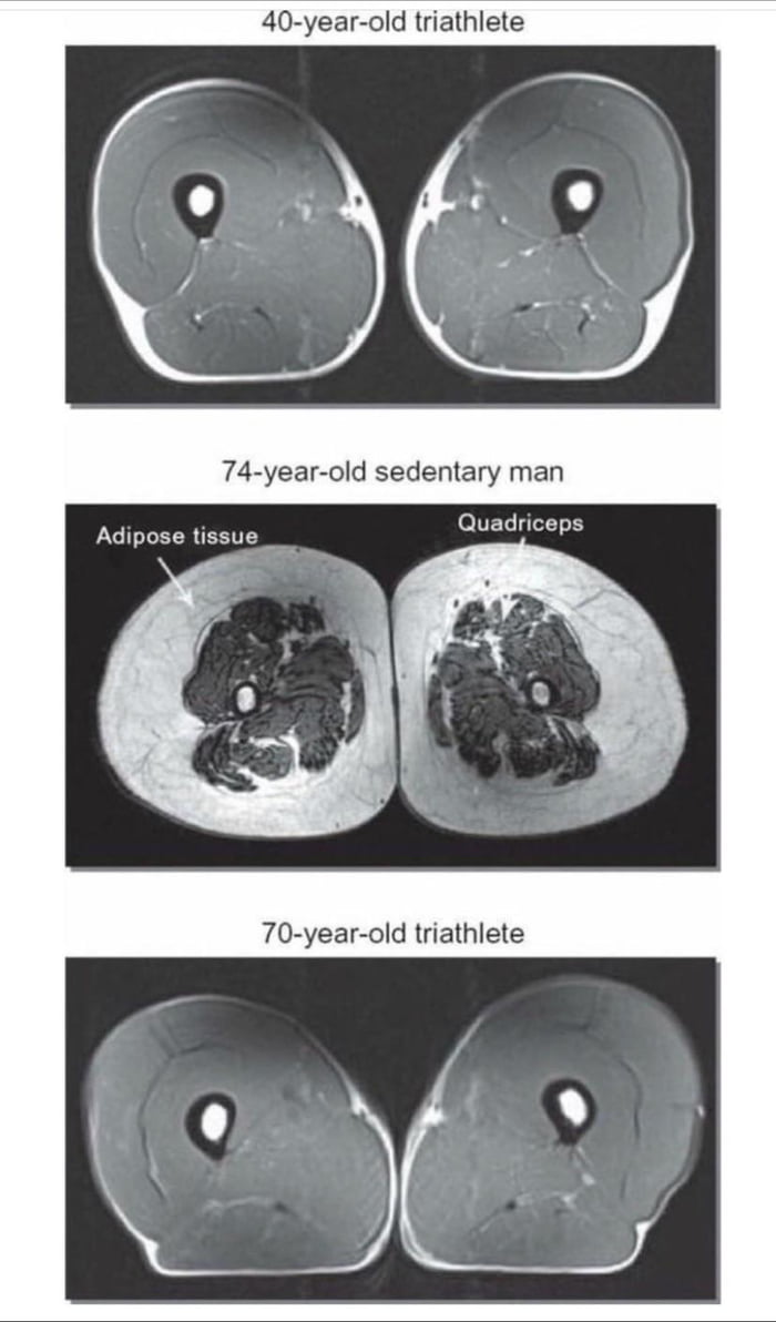 mri-results-comparing-40-y-o-athlete-70-y-o-athlete-to-74-y-o
