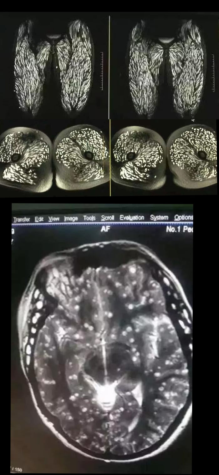Body Of A 23 Year Old Woman From China Riddled With Parasites As A body-of-a-23-year-old-woman-from-china-riddled-with-parasites-as-a