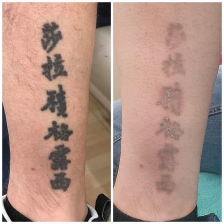 Tattoo Removal Before  After  Charlotte Huntersville NC Saluja Cosmetic  and Laser Center