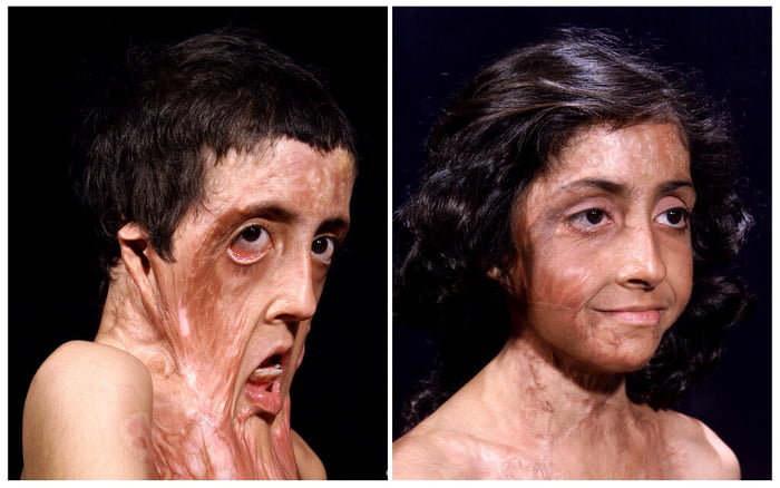 This burn victims facial reconstruction